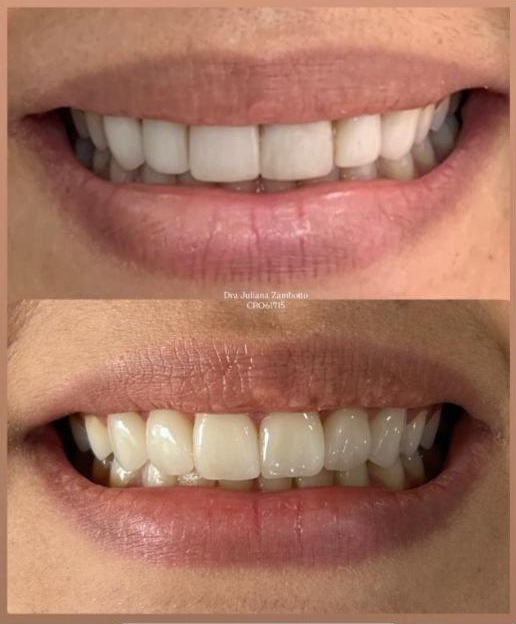 Antes e depois de lentes dentais